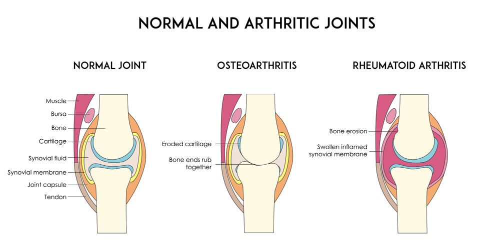 Arthritis