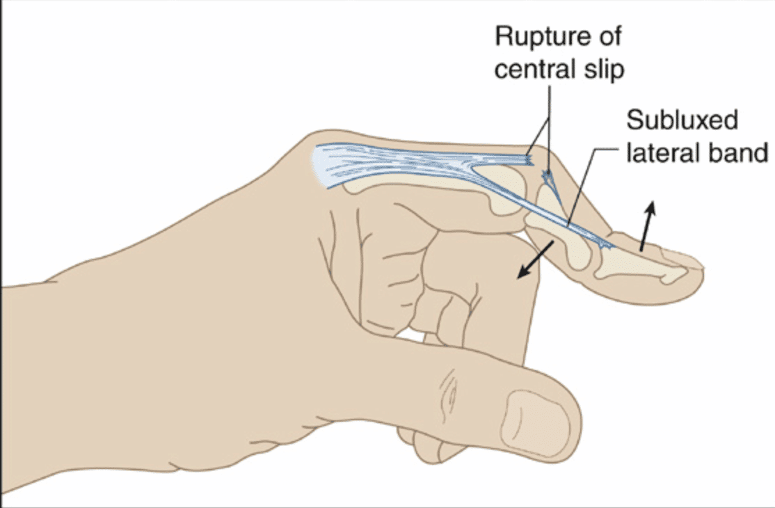 Central Slip Injuries Central Slip Injuries