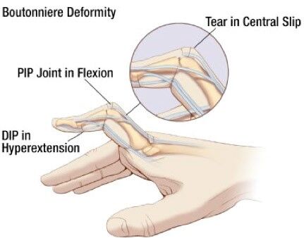 Boutonniere deformity