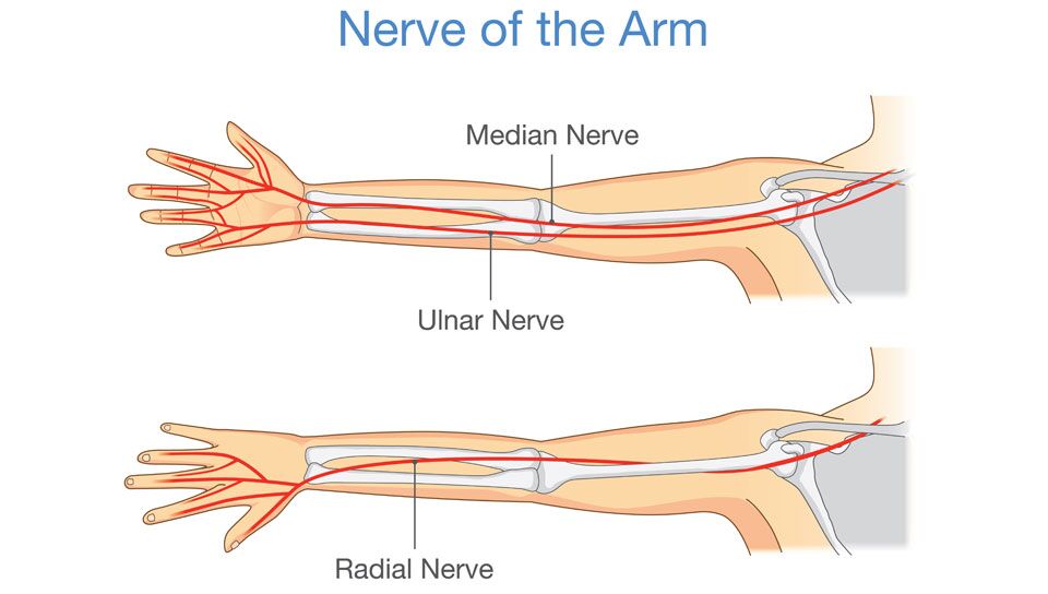 Radial tunnel syndrome Radial tunnel syndrome